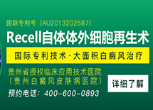 白癜风常识